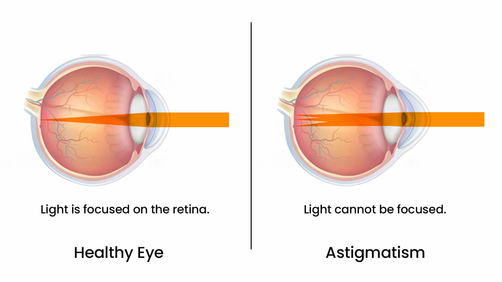 astigmatism vs normal vision