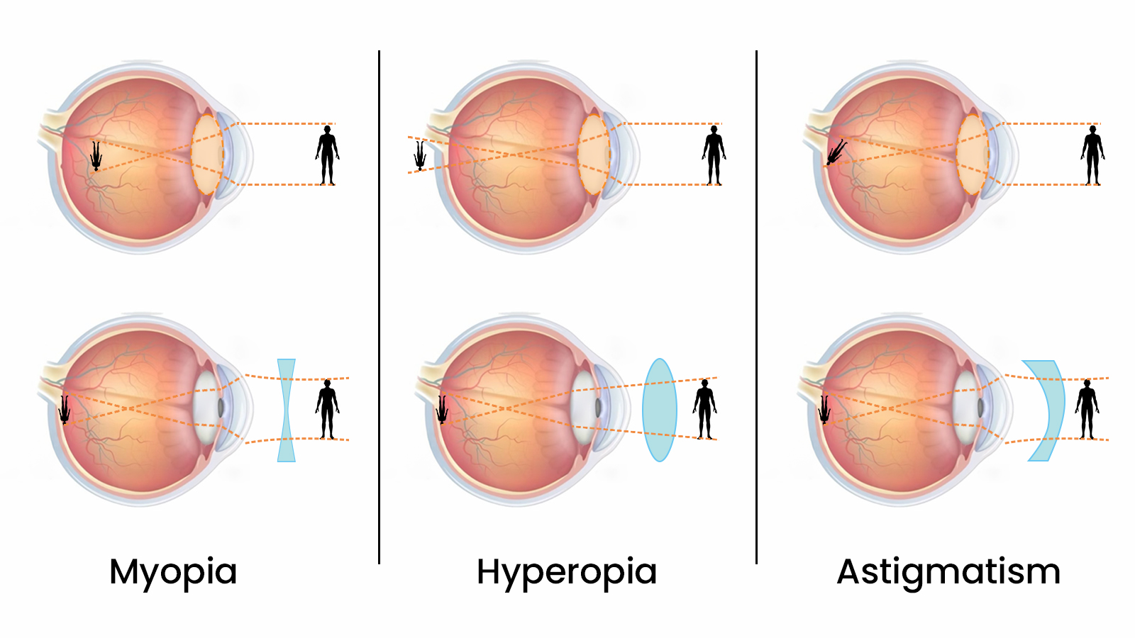 A medical illustration showing how corrective lenses for myopia, hyperopia, and astigmatism focus light correctly onto the retina.
