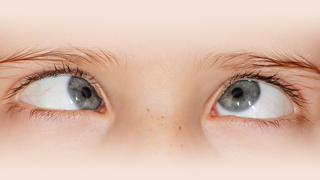 A breastfeeding child has cross-eyed symptoms